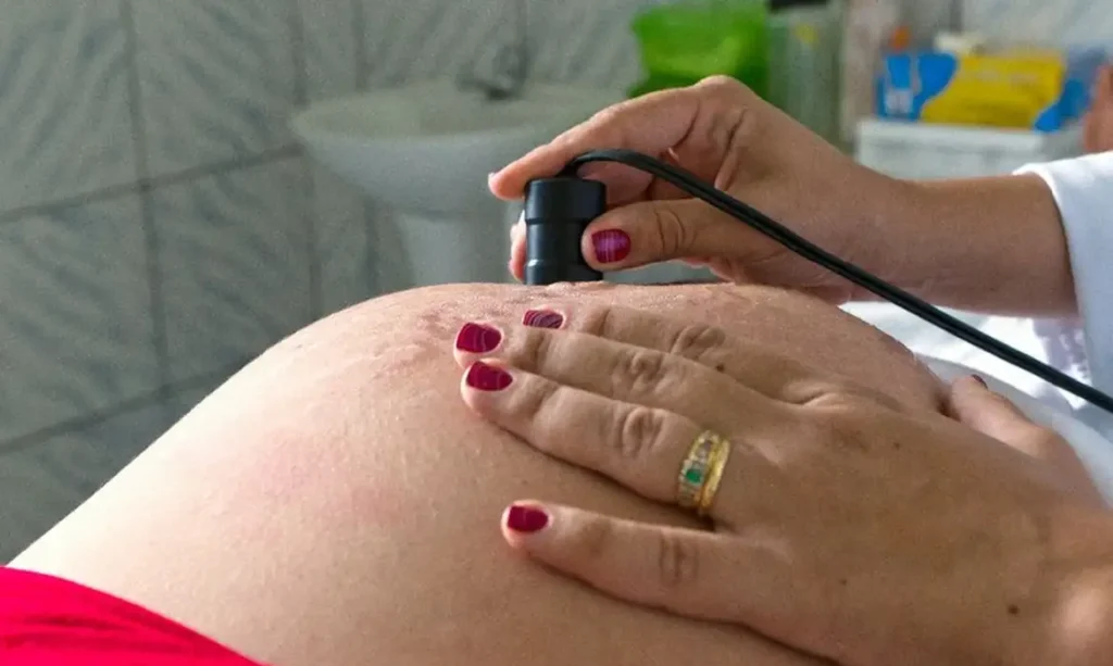 Ministério da Saúde recomenda cálcio para todas as gestantes para prevenir eclâmpsia