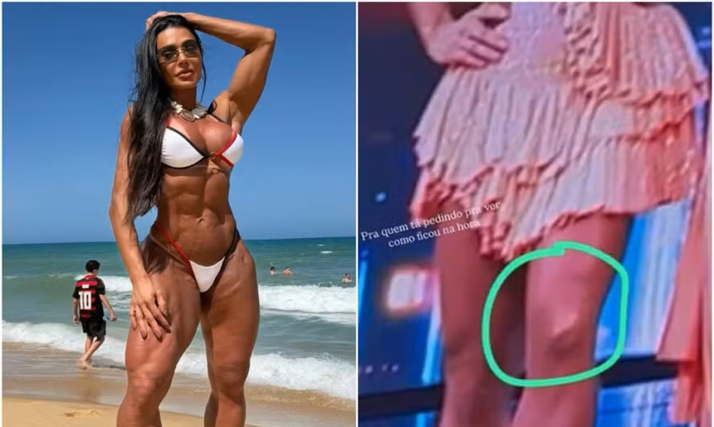 Gracyanne Barbosa desabafa 6 meses após lesão: “A maior batalha nunca foi só física”