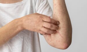 Verão exige cuidados contra alergias; dermatologista orienta sobre prevenção e sinais de alerta