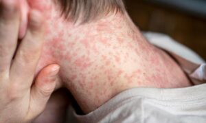 Sarampo: sintomas incluem manchas vermelhas e febre alta; vacinação é a principal forma de prevenção
