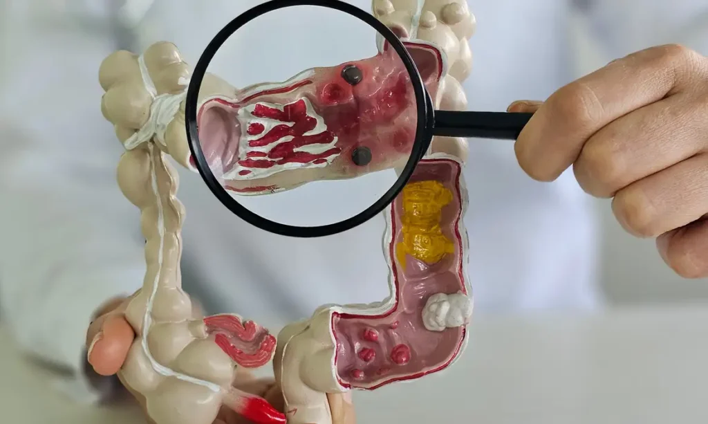 Em 13 anos, doença inflamatória intestinal cresce 5 vezes no Brasil 1 Em 13 anos, doença inflamatória intestinal cresce 5 vezes no Brasil